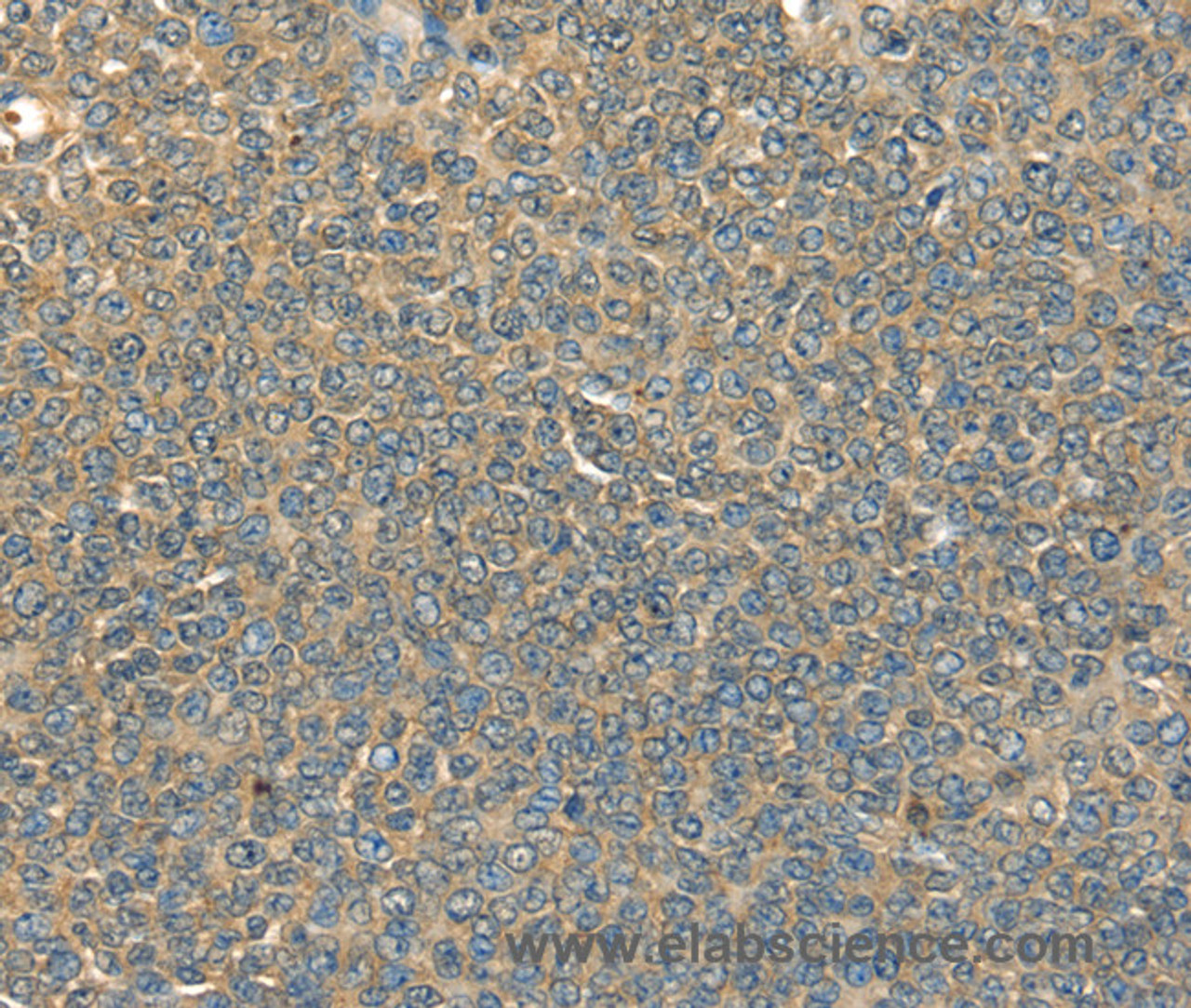 Immunohistochemistry of paraffin-embedded Human ovarian cancer tissue using DHCR24 Polyclonal Antibody at dilution 1:40