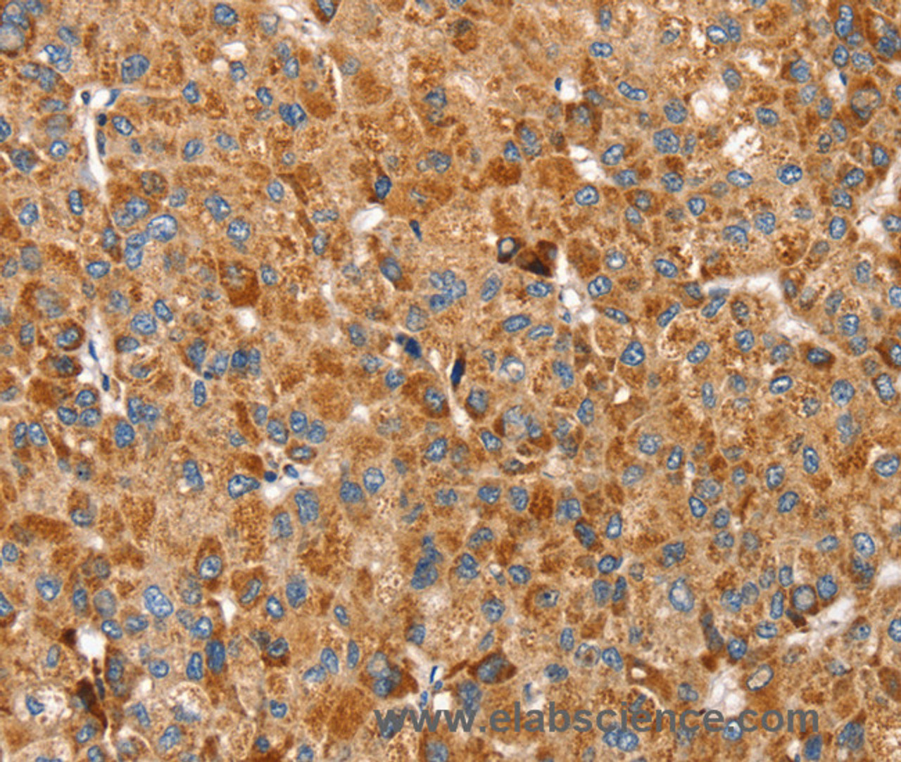 Immunohistochemistry of paraffin-embedded Human liver cancer using SSBP1 Polyclonal Antibody at dilution of 1:30