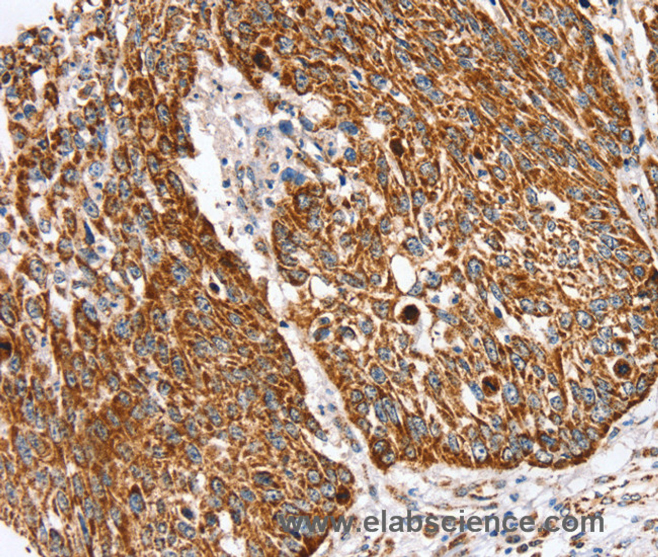 Immunohistochemistry of paraffin-embedded Human lung cancer using SSBP1 Polyclonal Antibody at dilution of 1:30