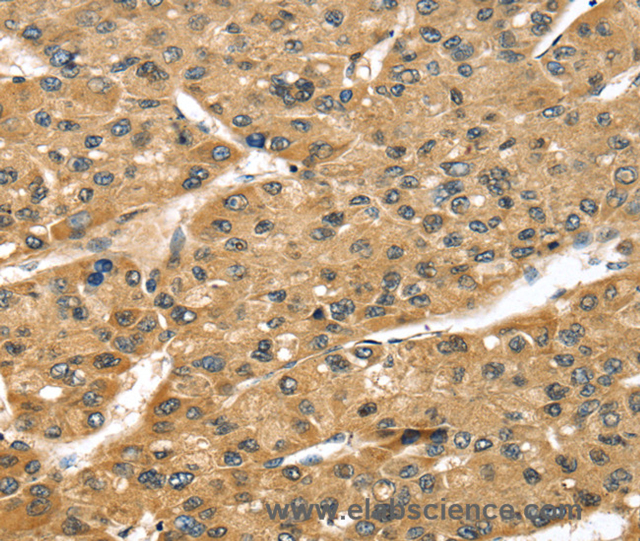 Immunohistochemistry of paraffin-embedded Human liver cancer tissue using STX8 Polyclonal Antibody at dilution 1:45