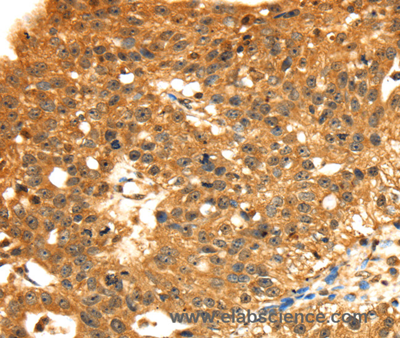 Immunohistochemistry of paraffin-embedded Human breast cancer tissue using STX8 Polyclonal Antibody at dilution 1:45