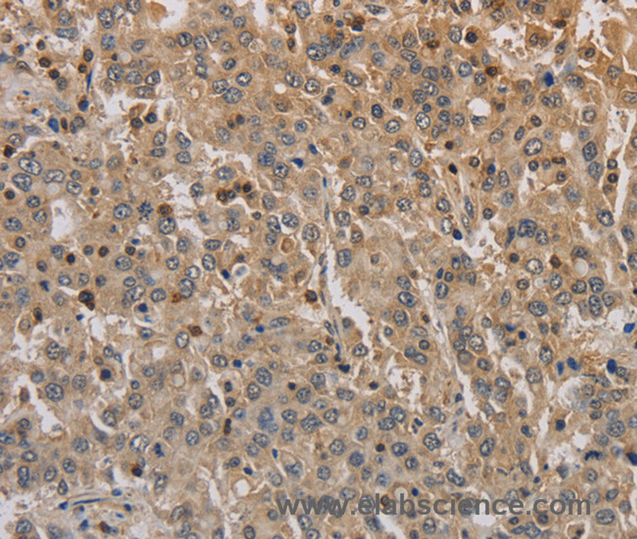 Immunohistochemistry of paraffin-embedded Human liver cancer using ADO Polyclonal Antibody at dilution of 1:30