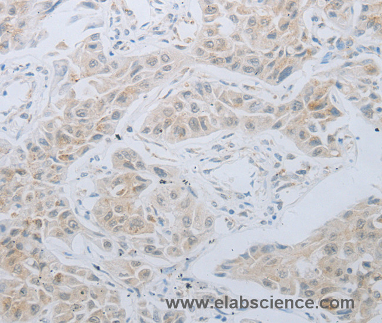 Immunohistochemistry of paraffin-embedded Human lung cancer using LOX Polyclonal Antibody at dilution of 1:30