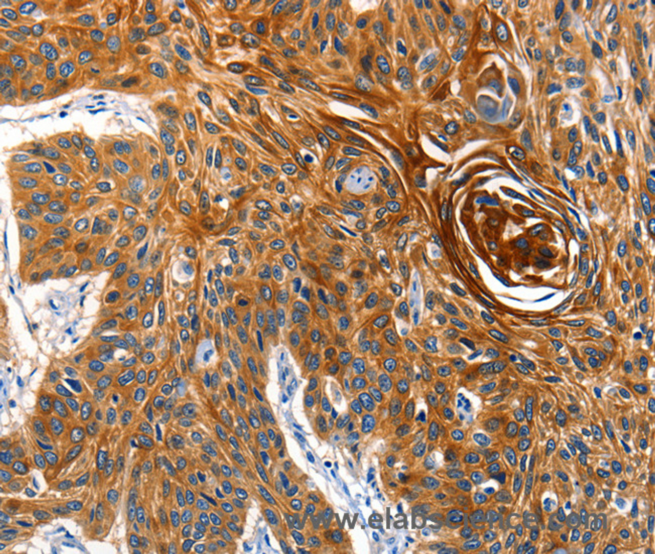 Immunohistochemistry of paraffin-embedded Human esophagus cancer tissue using AQP5 Polyclonal Antibody at dilution 1:40