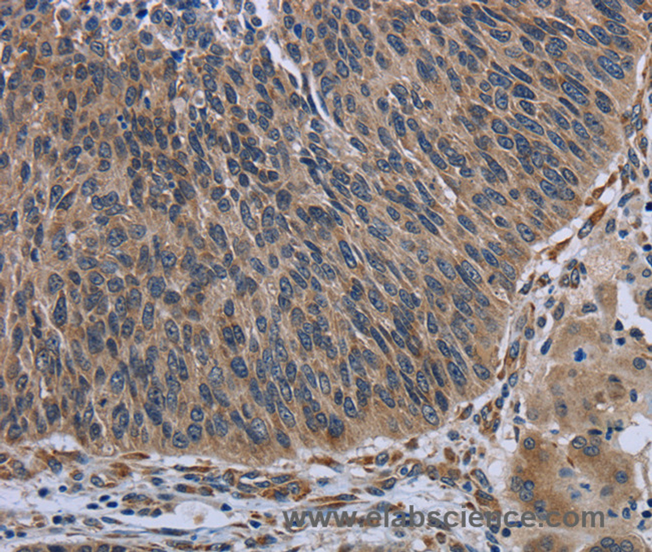 Immunohistochemistry of paraffin-embedded Human lung cancer using AVEN Polyclonal Antibody at dilution of 1:30