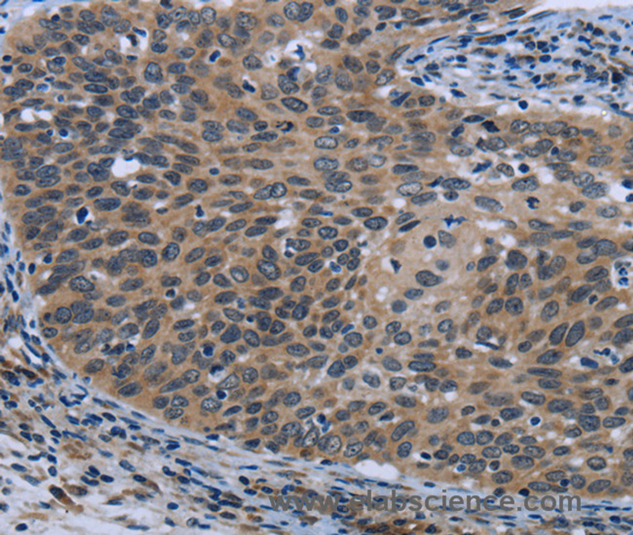 Immunohistochemistry of paraffin-embedded Human cervical cancer using AVEN Polyclonal Antibody at dilution of 1:30