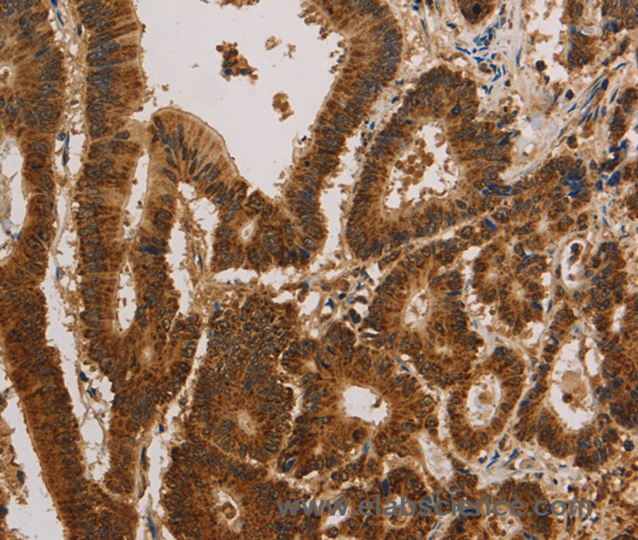 Immunohistochemistry of paraffin-embedded Human colon cancer tissue using CSNK2B Polyclonal Antibody at dilution 1:30