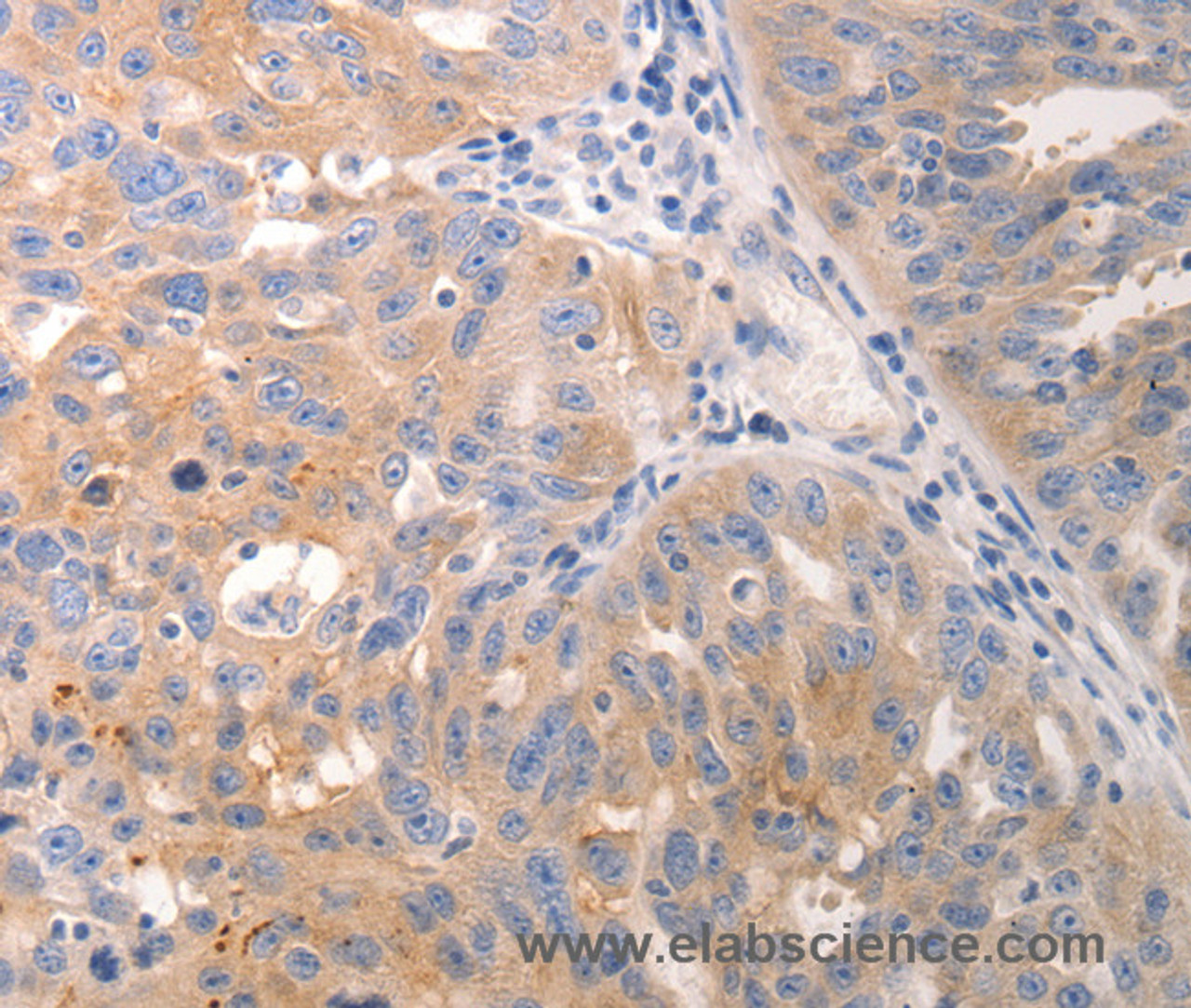 Immunohistochemistry of paraffin-embedded Human breast cancer tissue using CK-6A/B/C Polyclonal Antibody at dilution 1:50