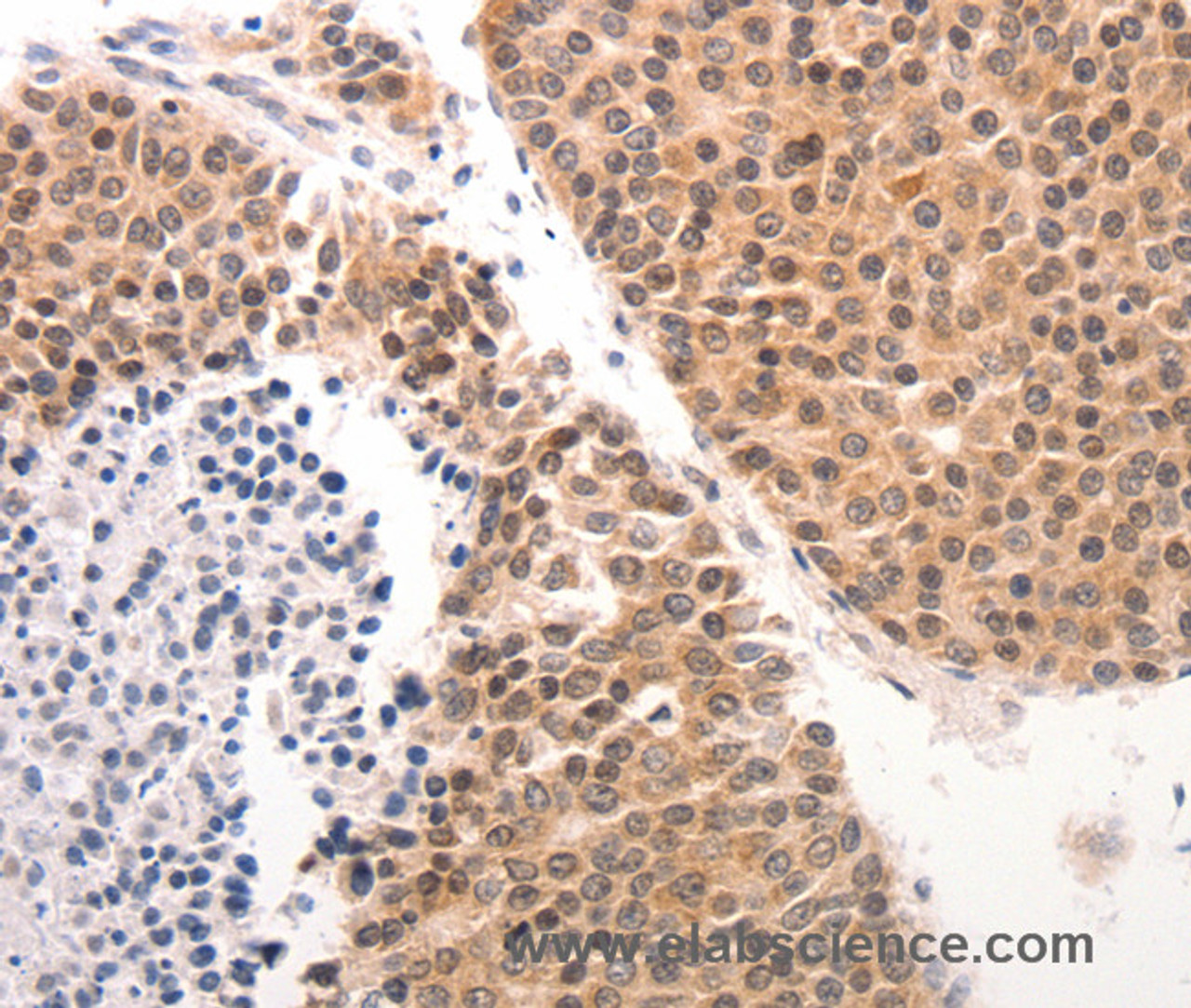 Immunohistochemistry of paraffin-embedded Human ovarian cancer tissue using CK-6A/B/C Polyclonal Antibody at dilution 1:50