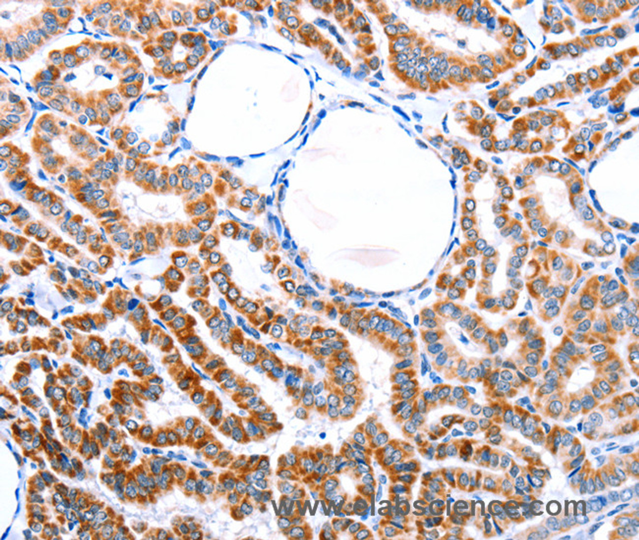 Immunohistochemistry of paraffin-embedded Human thyroid cancer tissue using ER alpha Polyclonal Antibody at dilution 1:76