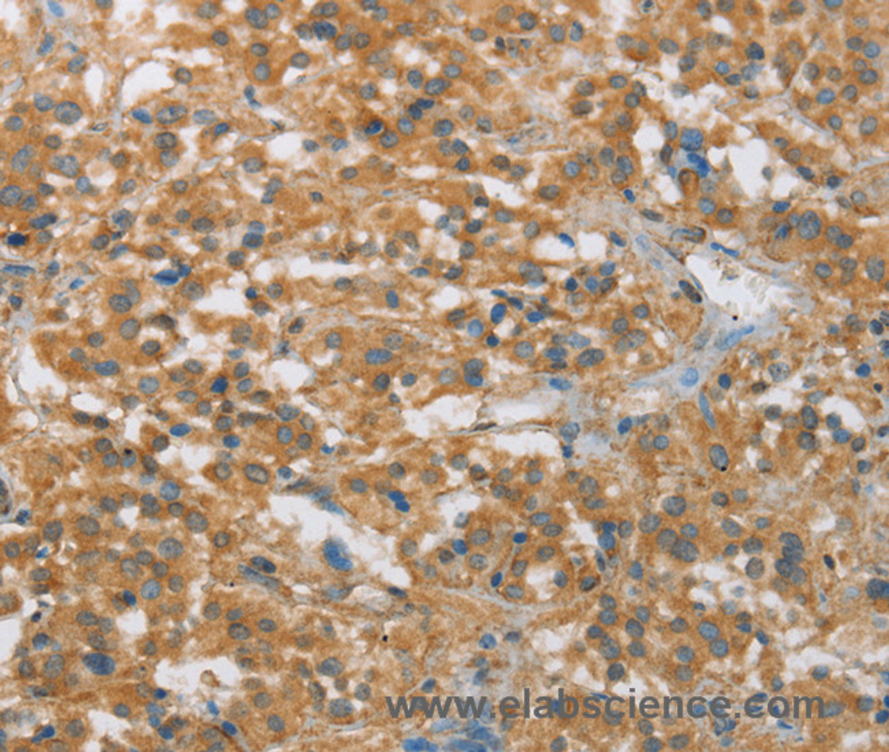 Immunohistochemistry of paraffin-embedded Human thyroid cancer tissue using FASLG Polyclonal Antibody at dilution 1:30