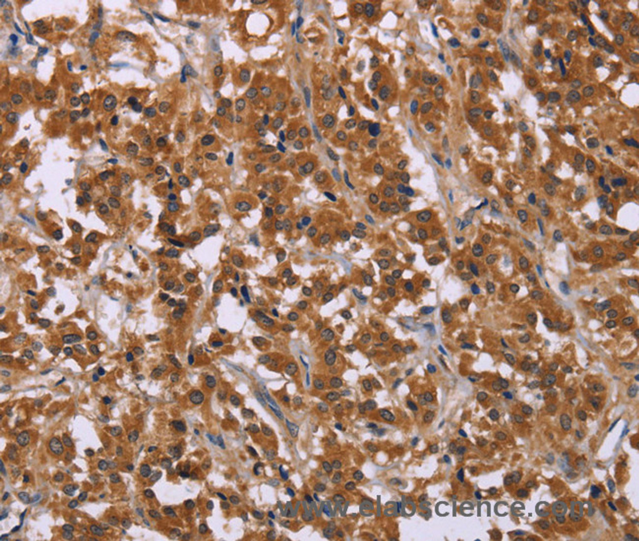Immunohistochemistry of paraffin-embedded Human thyroid cancer using CMTM6 Polyclonal Antibody at dilution of 1:30