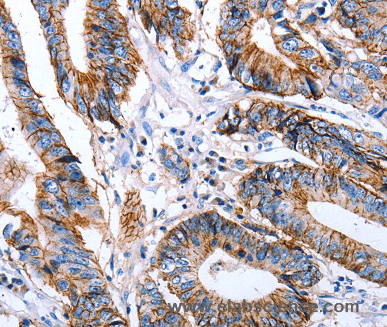 Immunohistochemistry of paraffin-embedded Human colon cancer using Claudin 7 Polyclonal Antibody at dilution of 1:50
