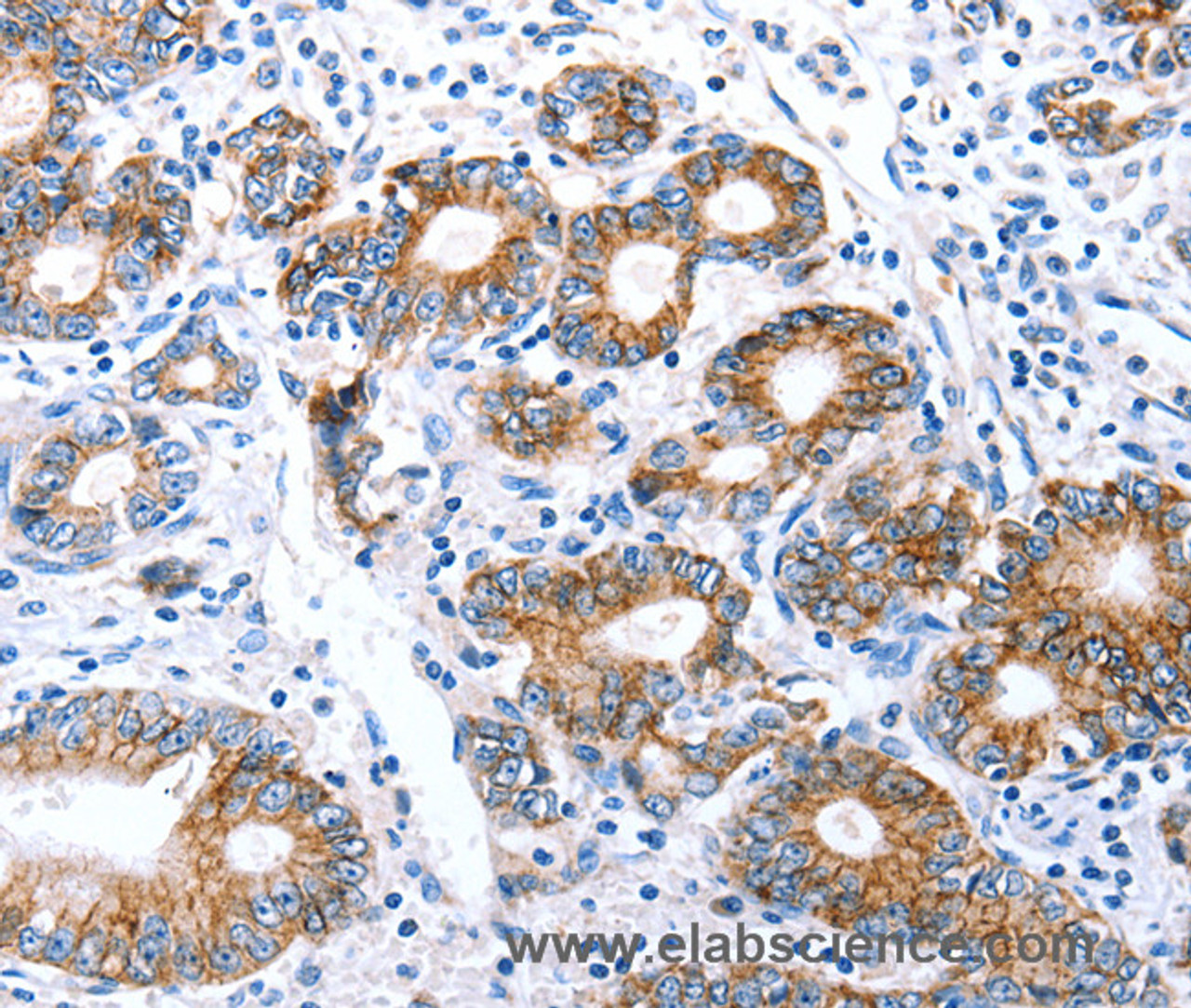 Immunohistochemistry of paraffin-embedded Human stomach cancer using Claudin 7 Polyclonal Antibody at dilution of 1:50