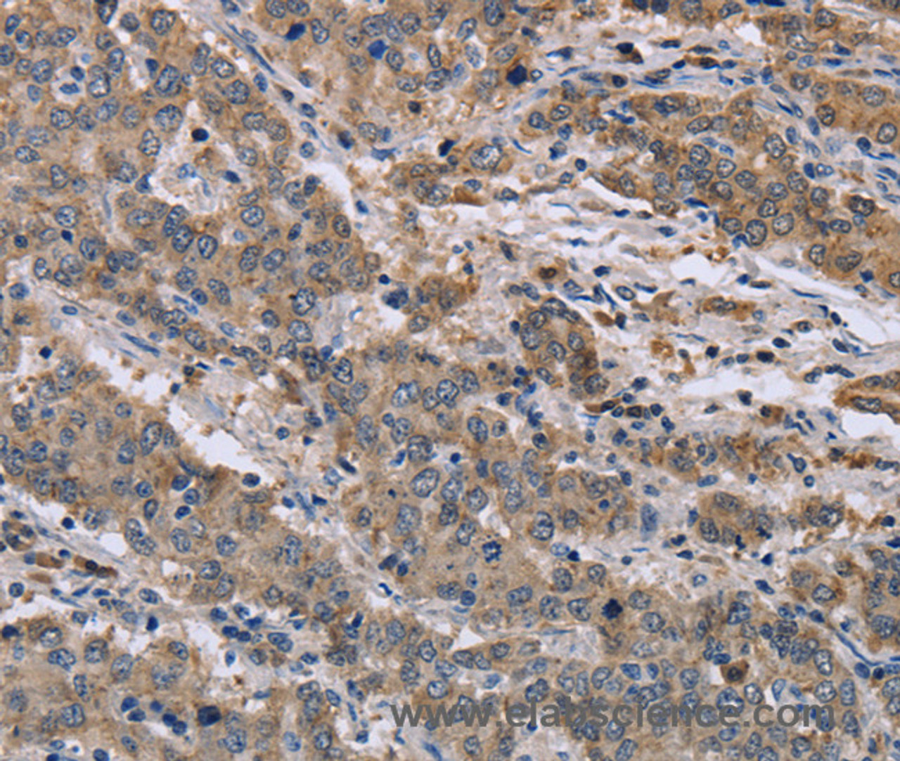 Immunohistochemistry of paraffin-embedded Human liver cancer tissue using GSN Polyclonal Antibody at dilution 1:40