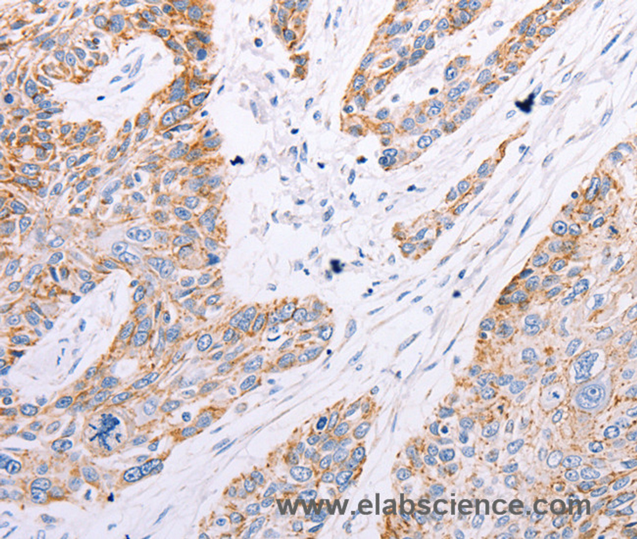 Immunohistochemistry of paraffin-embedded Human esophagus cancer tissue using GFRA3 Polyclonal Antibody at dilution 1:60