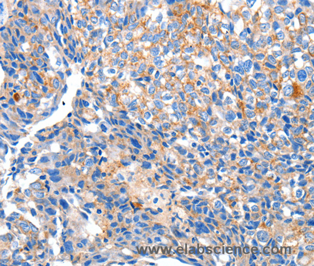 Immunohistochemistry of paraffin-embedded Human breast cancer tissue using HCN2 Polyclonal Antibody at dilution 1:80