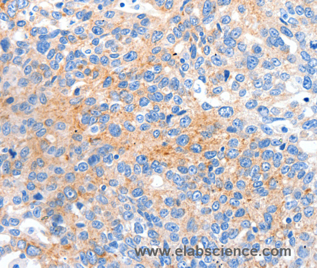 Immunohistochemistry of paraffin-embedded Human ovarian cancer tissue using HCN2 Polyclonal Antibody at dilution 1:80