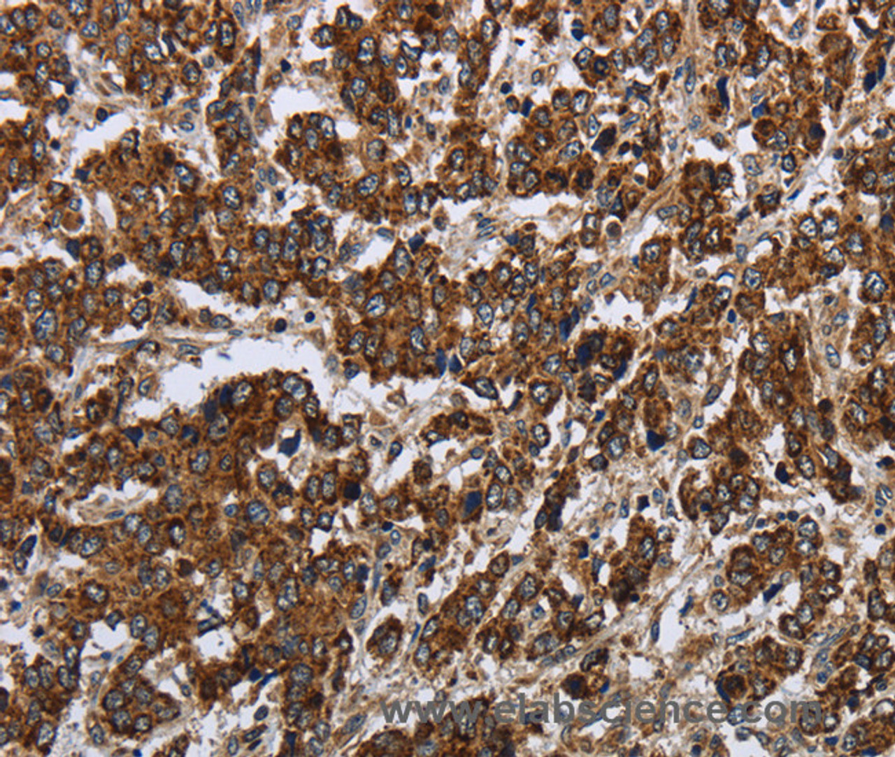 Immunohistochemistry of paraffin-embedded Human liver cancer using PPP1R13L Polyclonal Antibody at dilution of 1:30