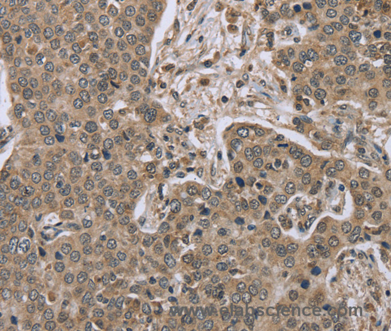 Immunohistochemistry of paraffin-embedded Human liver cancer tissue using IL15RA Polyclonal Antibody at dilution 1:45