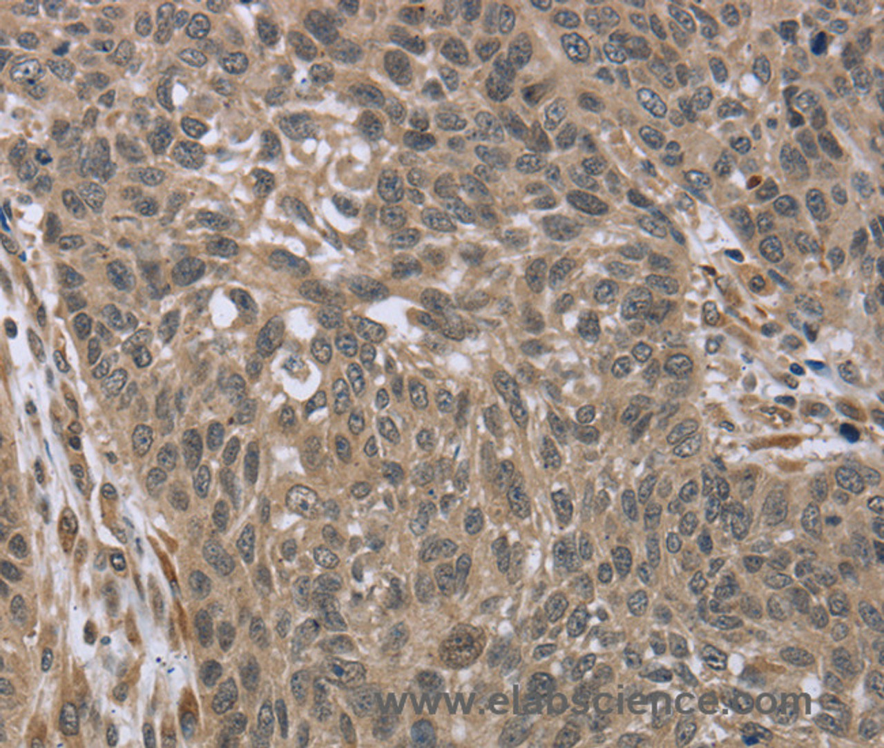 Immunohistochemistry of paraffin-embedded Human lung cancer tissue using IL15RA Polyclonal Antibody at dilution 1:45