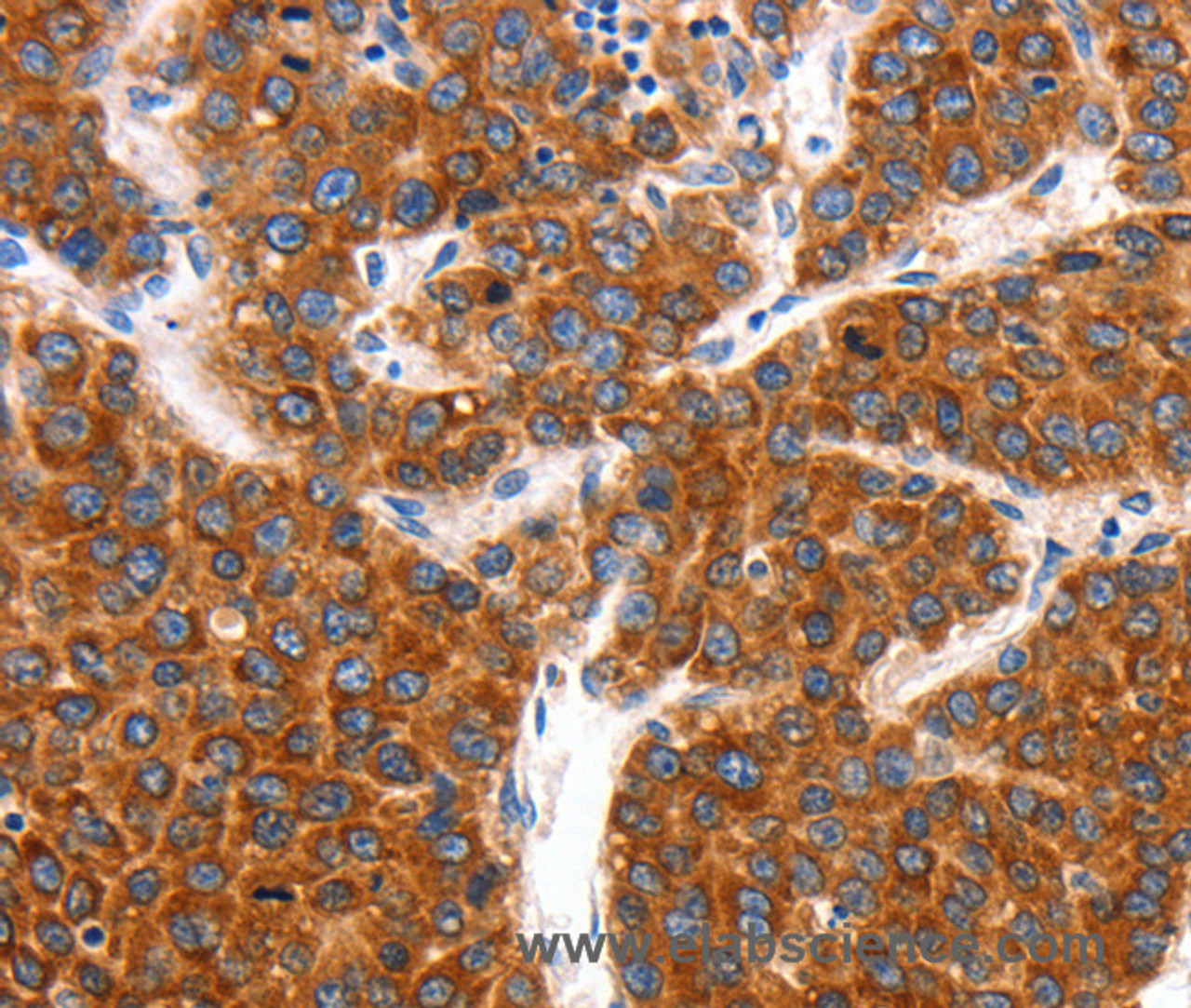 Immunohistochemistry of paraffin-embedded Human liver cancer tissue using KCNC2 Polyclonal Antibody at dilution 1:100