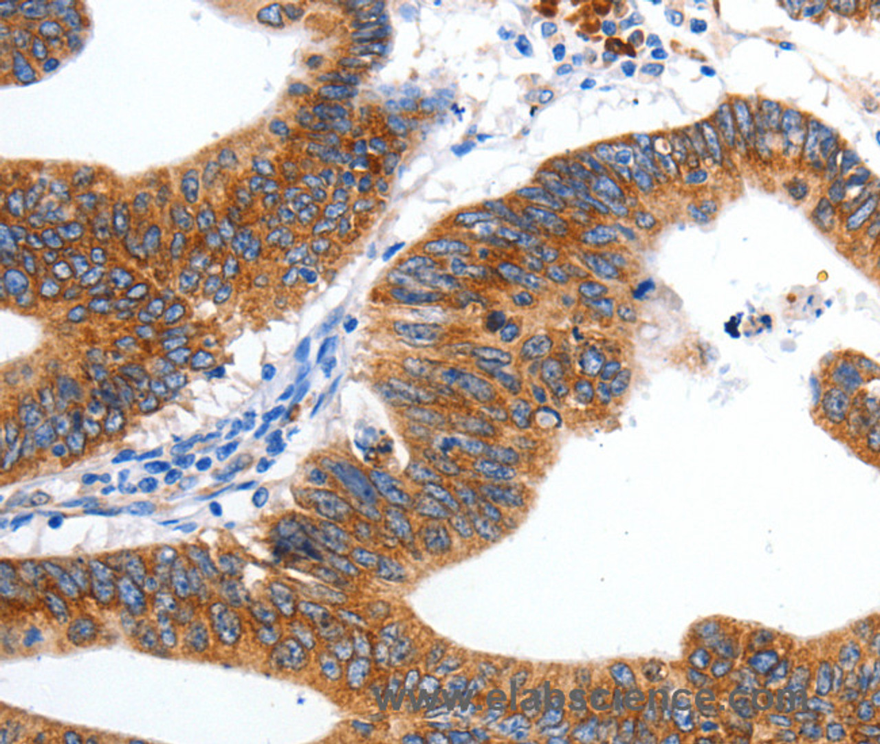 Immunohistochemistry of paraffin-embedded Human colon cancer tissue using KCNC2 Polyclonal Antibody at dilution 1:100