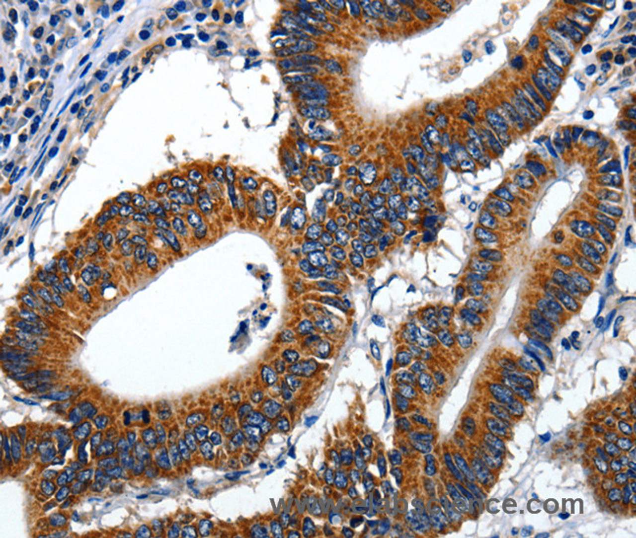 Immunohistochemistry of paraffin-embedded Human colon cancer using LAMA1 Polyclonal Antibody at dilution of 1:70