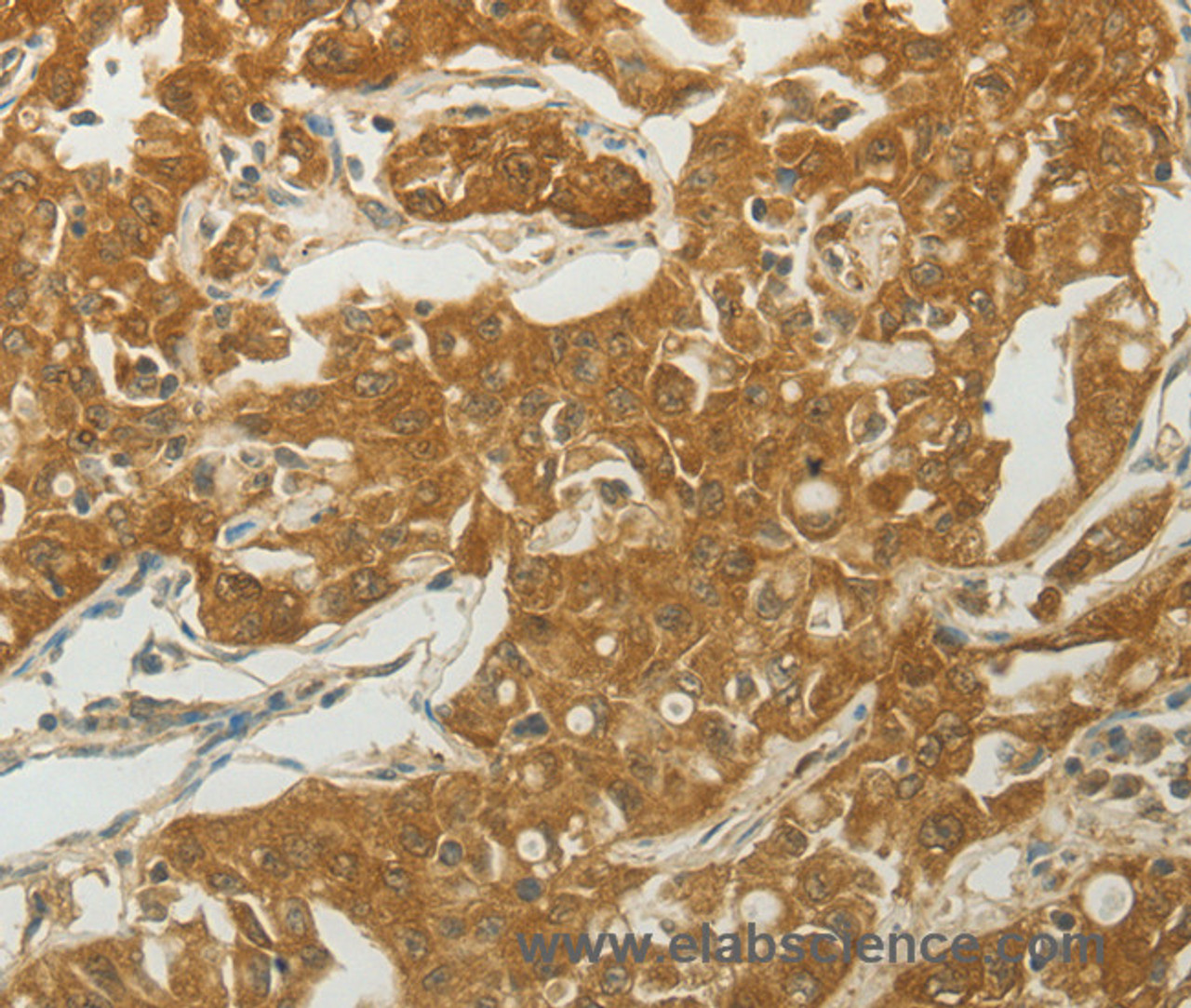 Immunohistochemistry of paraffin-embedded Human ovarian cancer tissue using MC4R Polyclonal Antibody at dilution 1:50