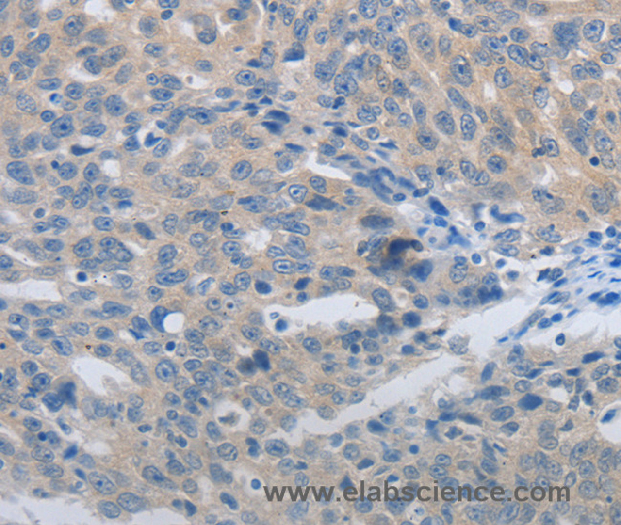 Immunohistochemistry of paraffin-embedded Human ovarian cancer using MMP8 Polyclonal Antibody at dilution of 1:45