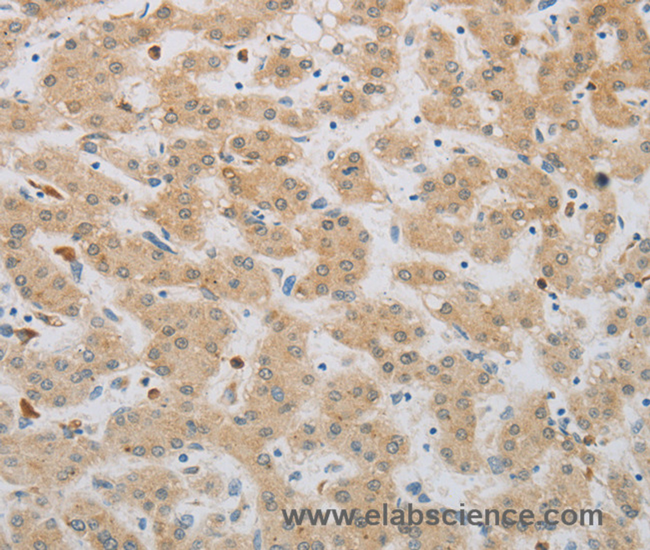 Immunohistochemistry of paraffin-embedded Human liver cancer tissue using NBN Polyclonal Antibody at dilution 1:50