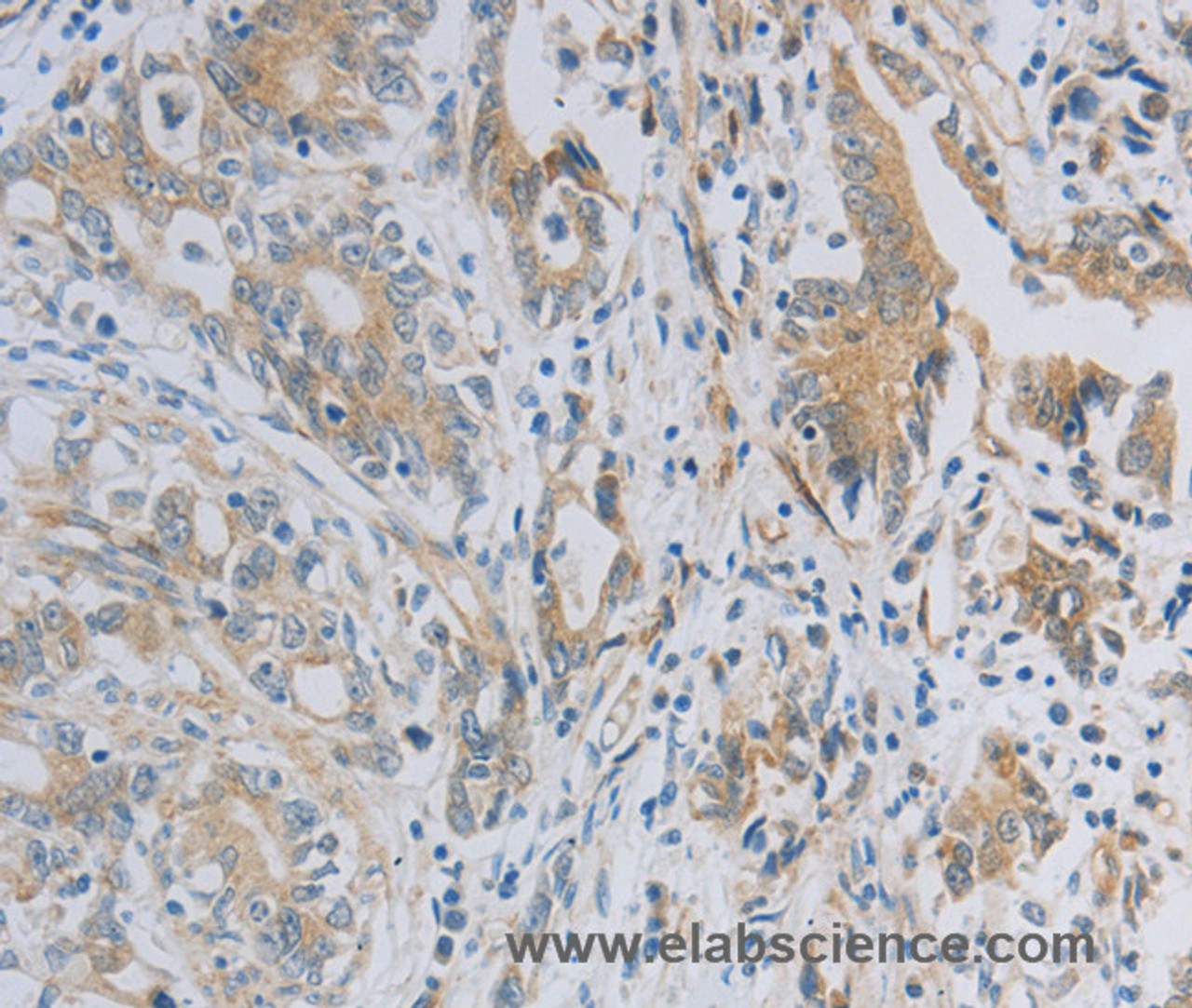 Immunohistochemistry of paraffin-embedded Human gastric cancer tissue using NBN Polyclonal Antibody at dilution 1:50