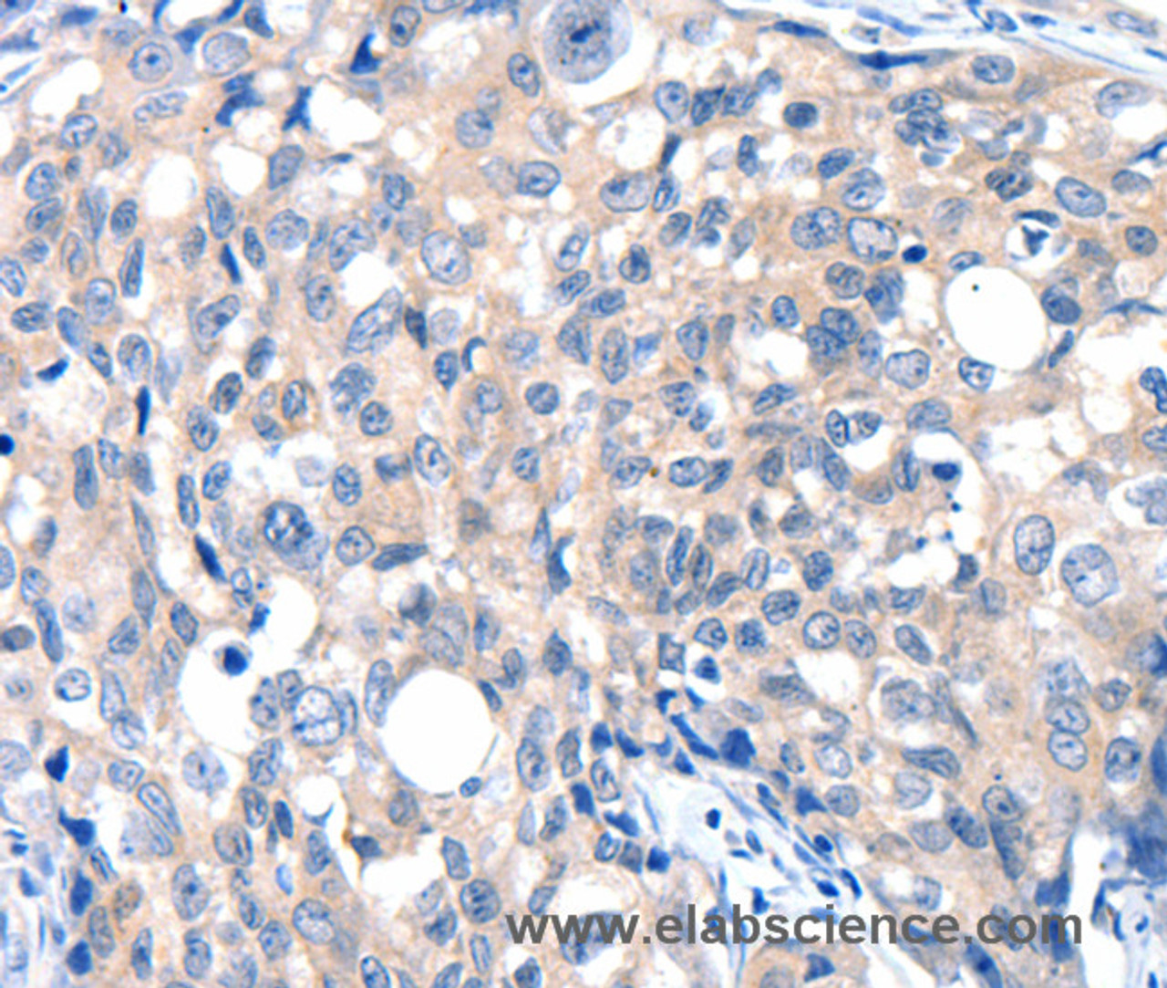 Immunohistochemistry of paraffin-embedded Human breast cancer tissue using GRIN2D Polyclonal Antibody at dilution 1:30