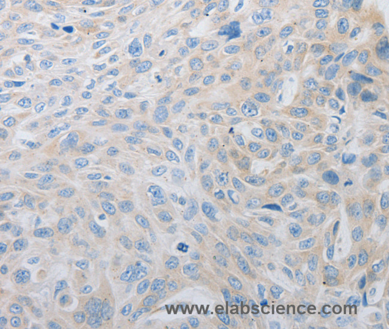 Immunohistochemistry of paraffin-embedded Human esophagus cancer using PDX1 Polyclonal Antibody at dilution of 1:30