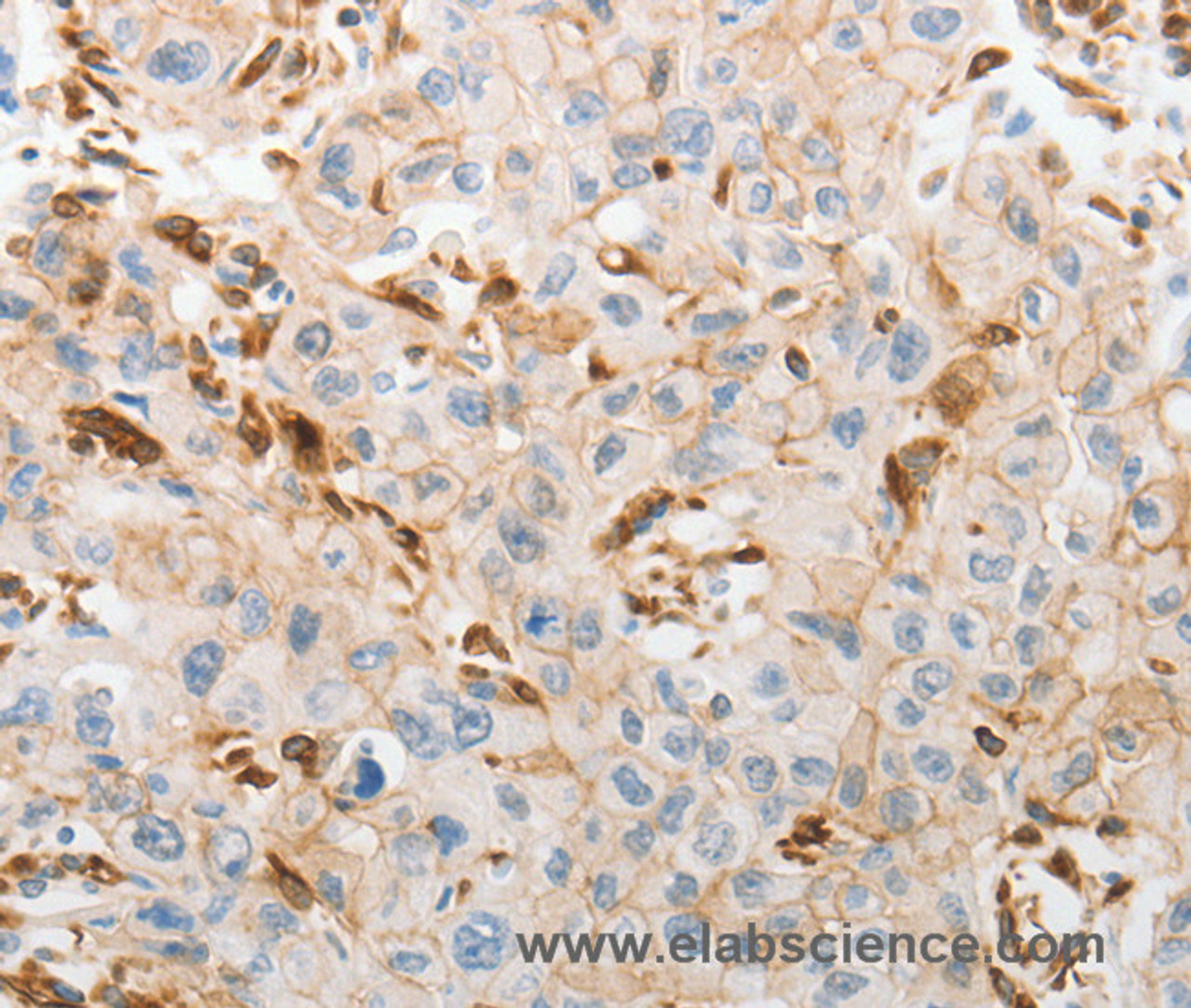 Immunohistochemistry of paraffin-embedded Human lung cancer tissue using SLC15A2 Polyclonal Antibody at dilution 1:60