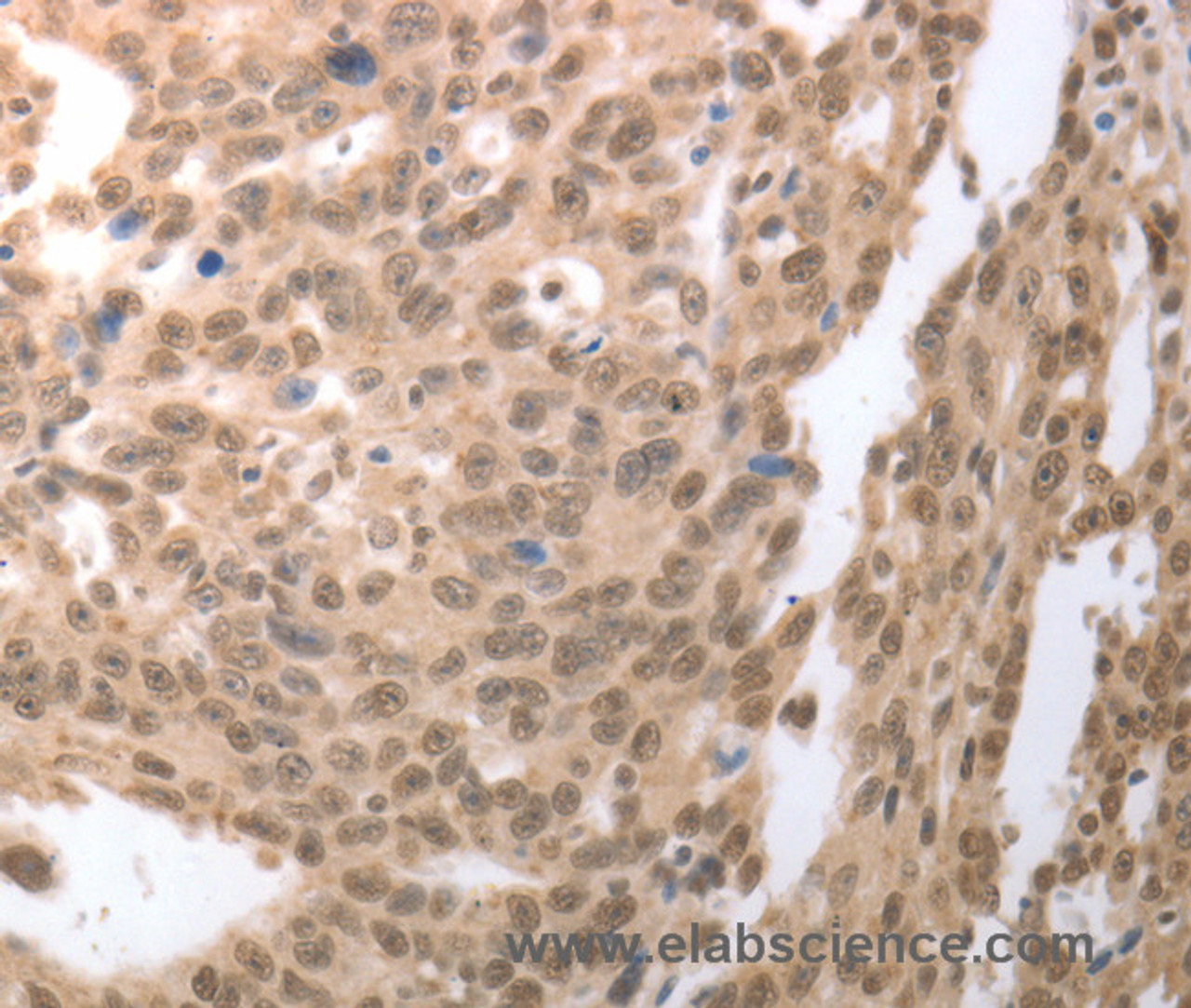 Immunohistochemistry of paraffin-embedded Human ovarian cancer tissue using RAD52 Polyclonal Antibody at dilution 1:50