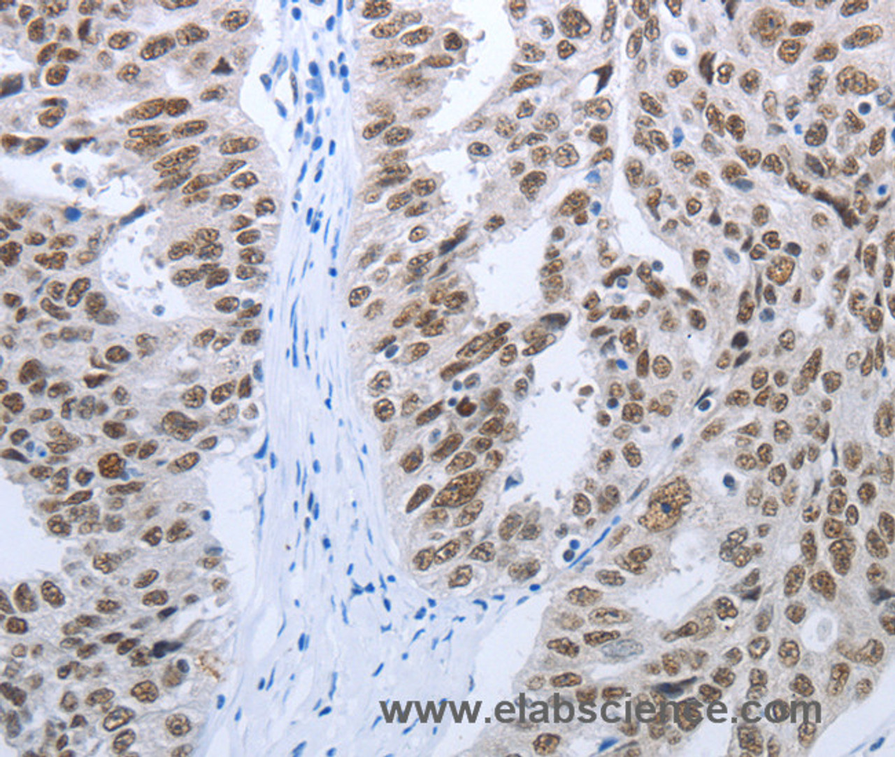 Immunohistochemistry of paraffin-embedded Human ovarian cancer tissue using RBMS1 Polyclonal Antibody at dilution 1:30