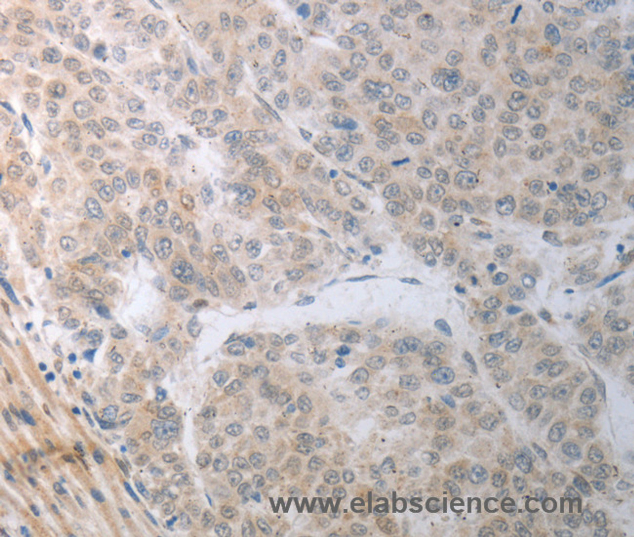 Immunohistochemistry of paraffin-embedded Human liver cancer using RBMS3 Polyclonal Antibody at dilution of 1:70