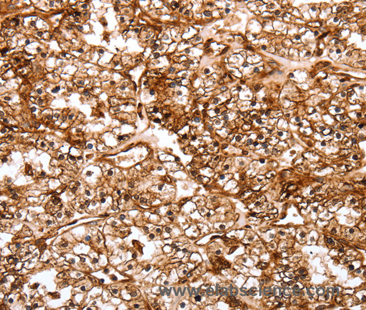 Immunohistochemistry of paraffin-embedded Human renal cancer tissue using SLC9A3R2 Polyclonal Antibody at dilution 1:40