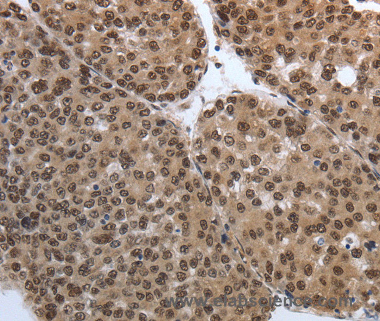 Immunohistochemistry of paraffin-embedded Human liver cancer tissue using SMAD7 Polyclonal Antibody at dilution 1:40