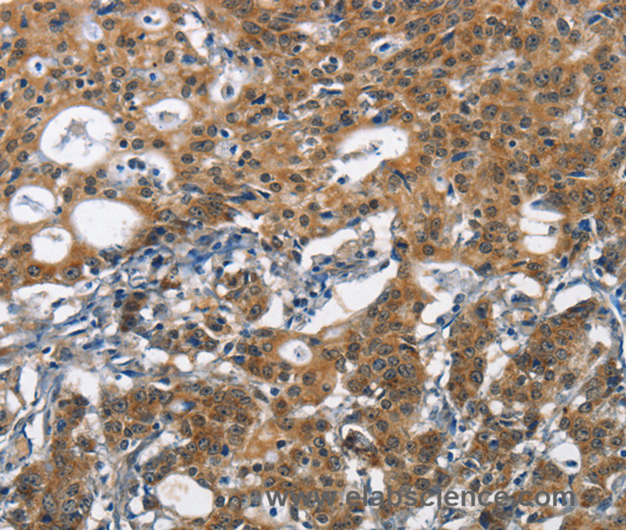 Immunohistochemistry of paraffin-embedded Human gasrtic cancer tissue using DCC Polyclonal Antibody at dilution 1:70