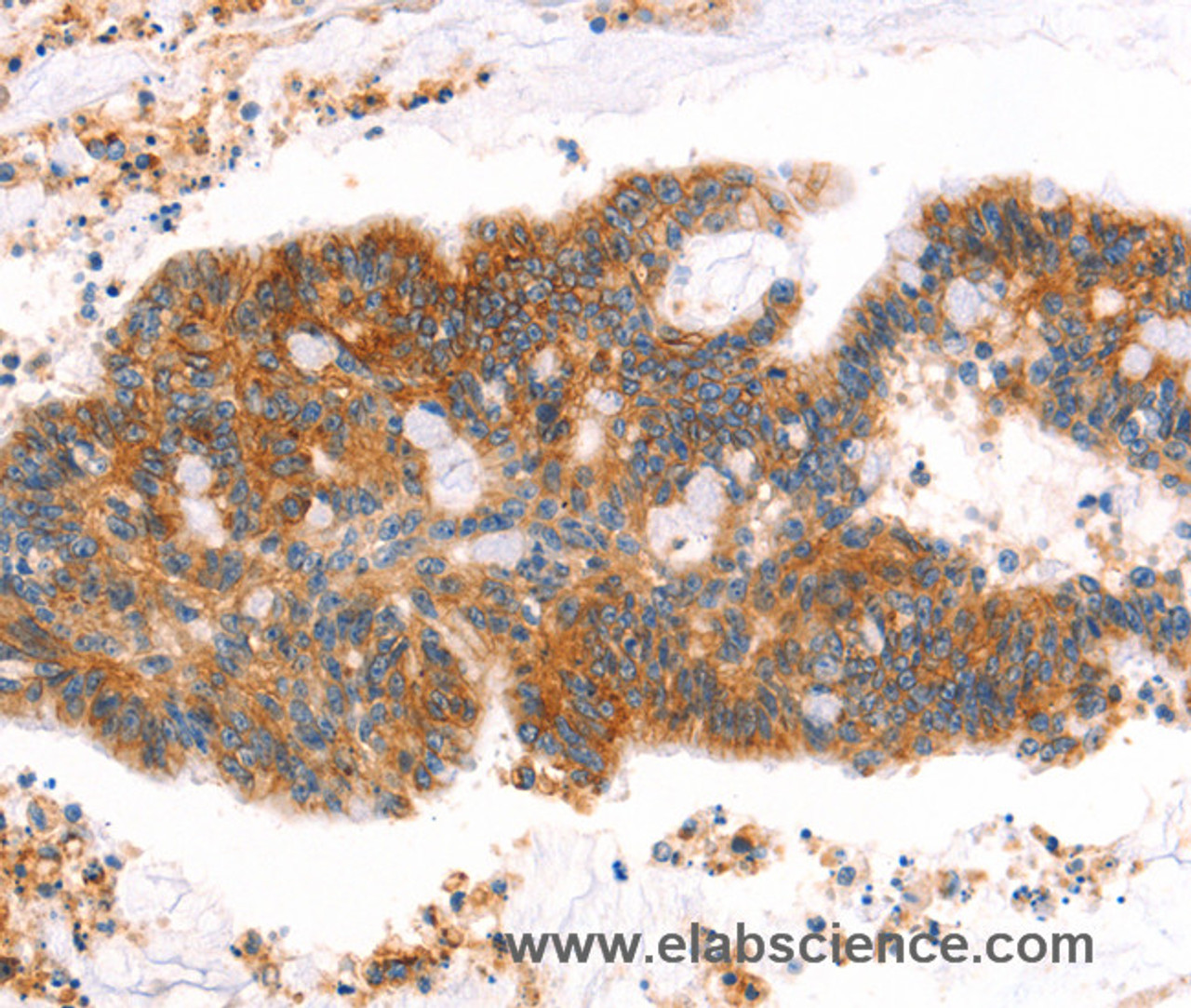 Immunohistochemistry of paraffin-embedded Human colon cancer tissue using AFDN Polyclonal Antibody at dilution 1:40