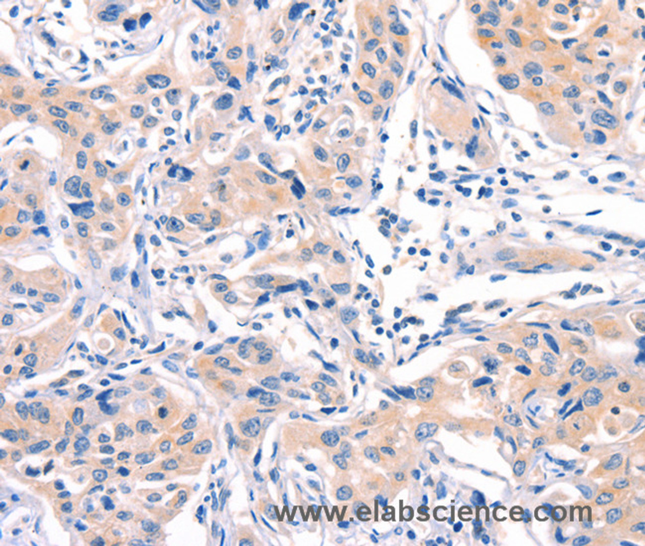 Immunohistochemistry of paraffin-embedded Human lung cancer tissue using AFDN Polyclonal Antibody at dilution 1:40