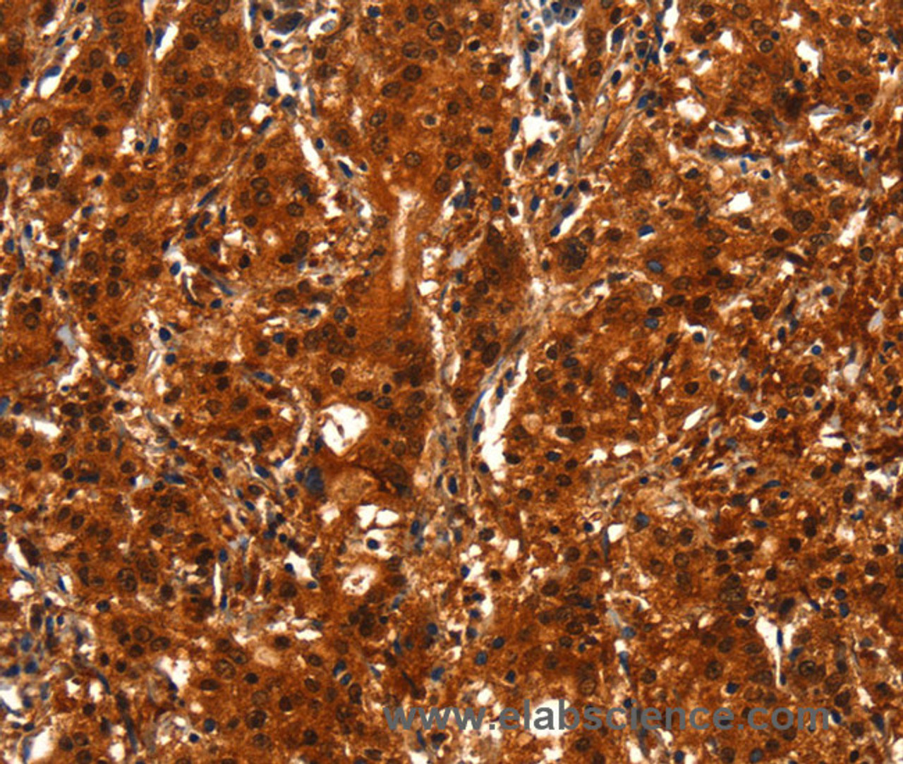 Immunohistochemistry of paraffin-embedded Human gasrtic cancer tissue using BCAS3 Polyclonal Antibody at dilution 1:40