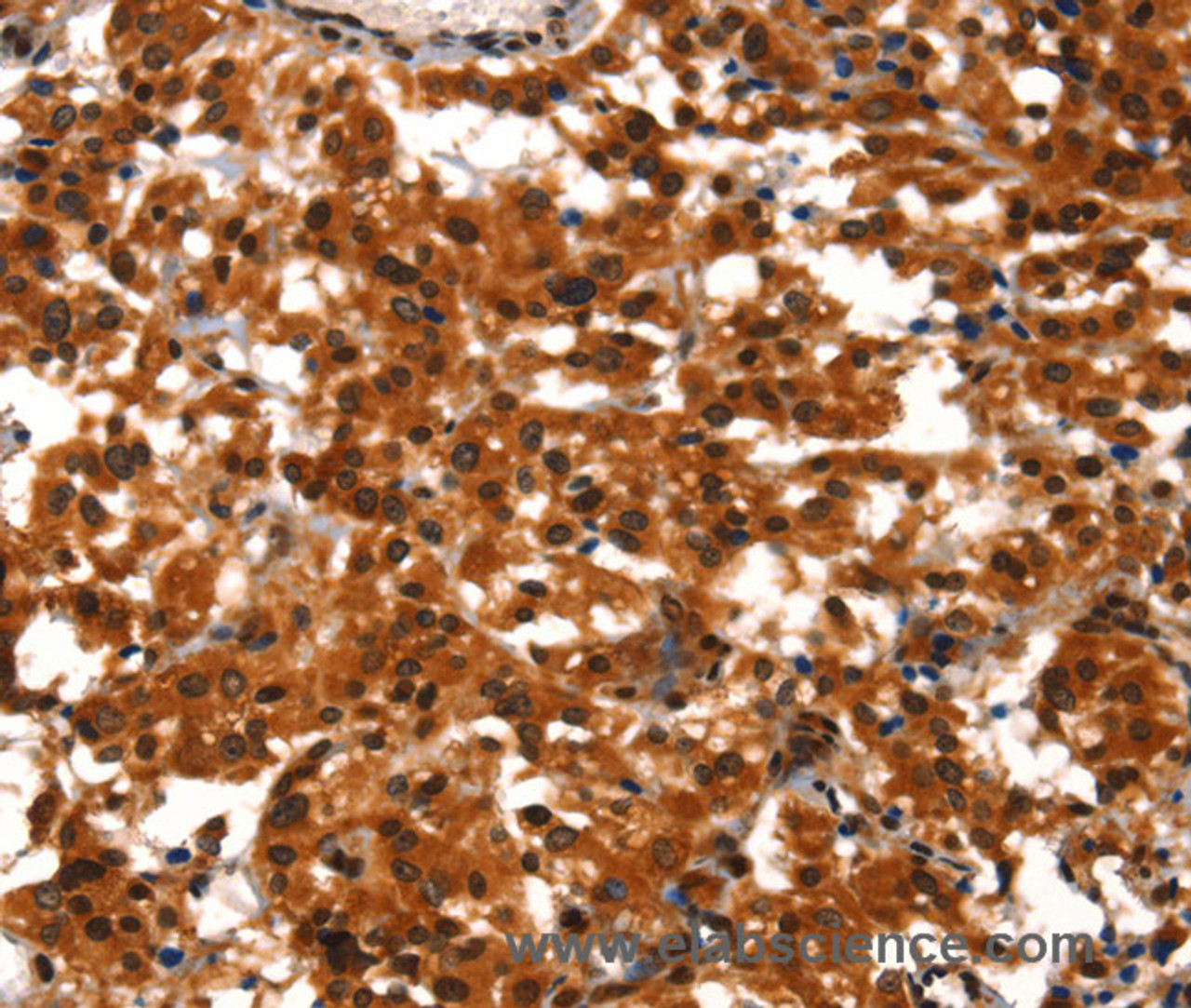 Immunohistochemistry of paraffin-embedded Human thyroid cancer tissue using BCAS3 Polyclonal Antibody at dilution 1:40