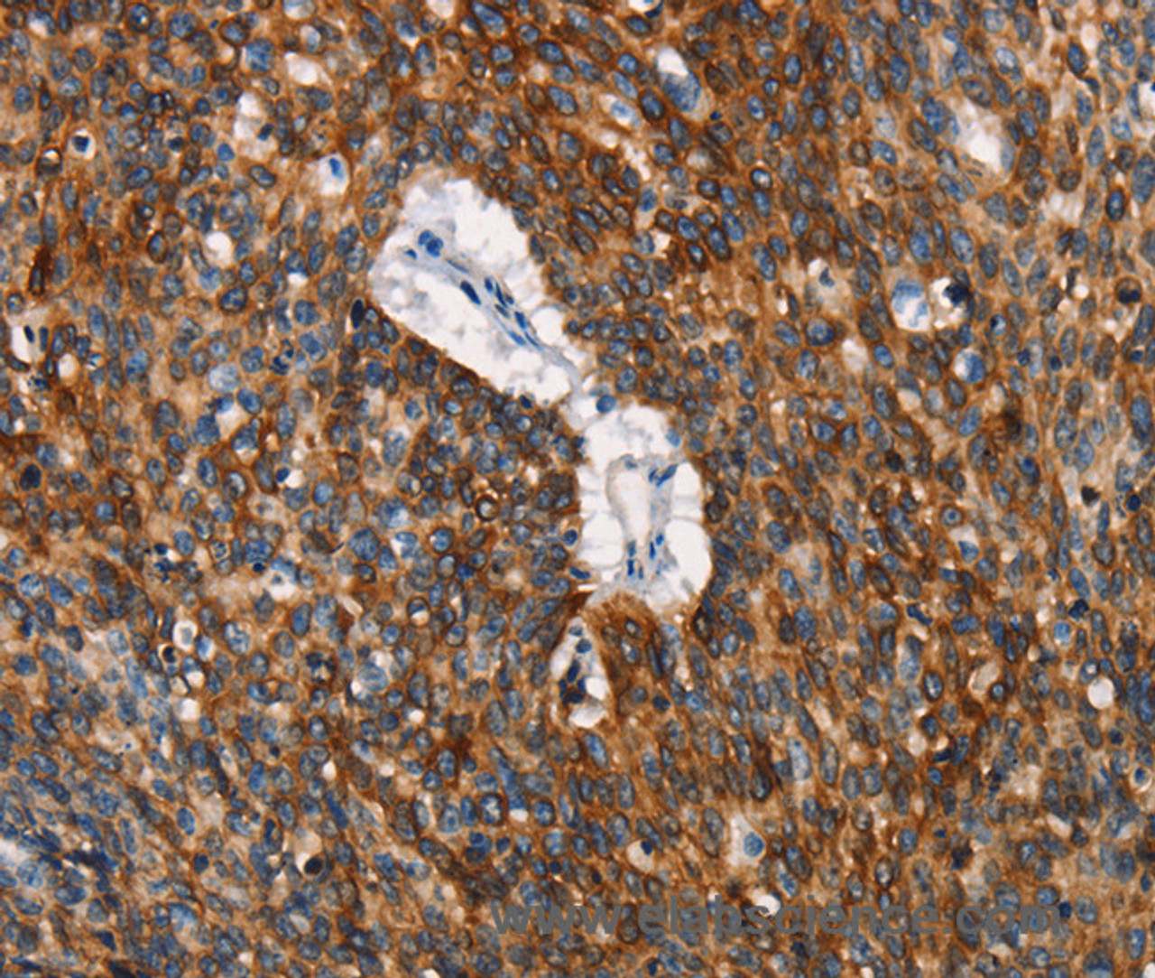 Immunohistochemistry of paraffin-embedded Human lung cancer tissue using CD68 Polyclonal Antibody at dilution 1:30