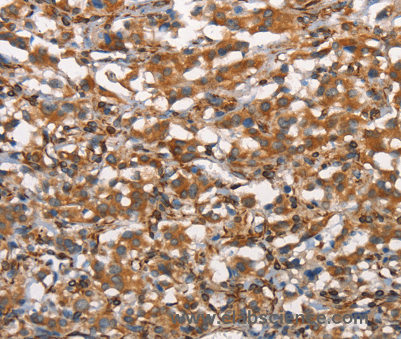 Immunohistochemistry of paraffin-embedded Human thyroid cancer tissue using CDC23 Polyclonal Antibody at dilution 1:50