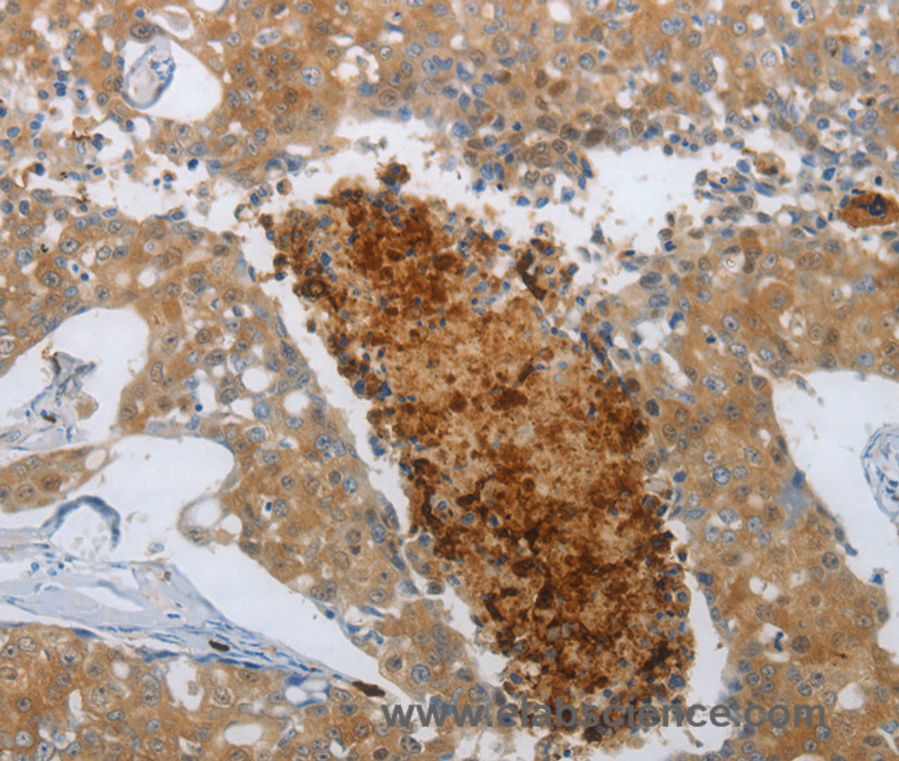 Immunohistochemistry of paraffin-embedded Human breast cancer using NGFR Polyclonal Antibody at dilution of 1:50