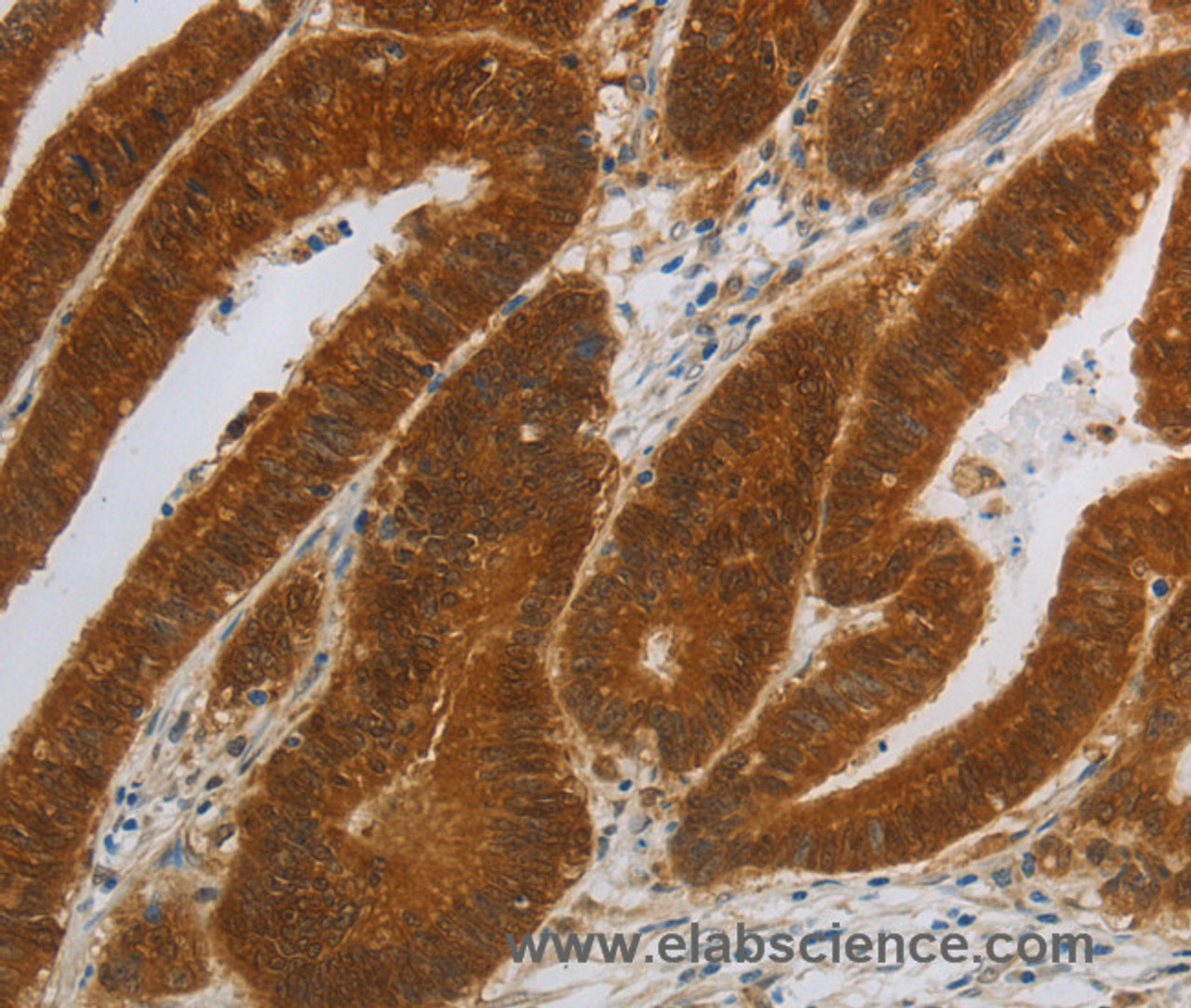 Immunohistochemistry of paraffin-embedded Human colon cancer using NIT2 Polyclonal Antibody at dilution of 1:40