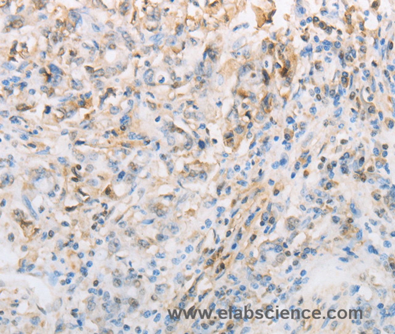 Immunohistochemistry of paraffin-embedded Human gasrtic cancer tissue using NPPC Polyclonal Antibody at dilution 1:70